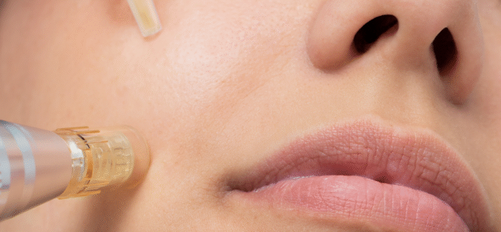 Altın İğne (Mikro İğne Radyofrekans) Uygulaması