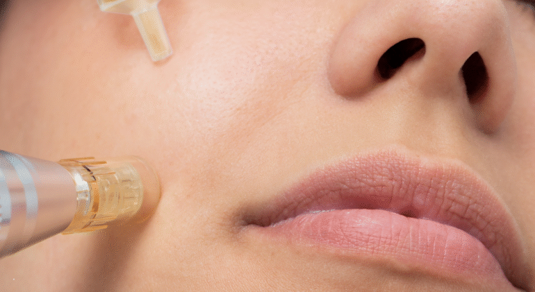 Altın İğne (Mikro İğne Radyofrekans) Uygulaması